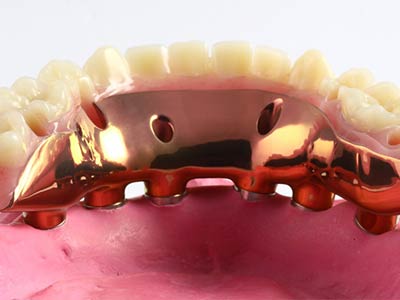 Clinique Cloutier denturologiste Montréal | Prothèse sur implants fixe amovible